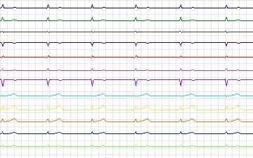 Electrocardiogram for T-Wave Alternans Challenge, record twa52