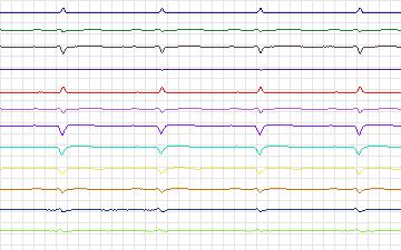 Electrocardiogram for T-Wave Alternans Challenge, record twa53