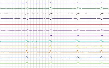Electrocardiogram for T-Wave Alternans Challenge, record twa54