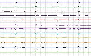 Electrocardiogram for T-Wave Alternans Challenge, record twa55