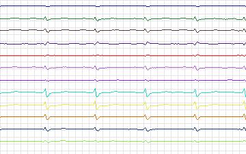 Electrocardiogram for T-Wave Alternans Challenge, record twa56