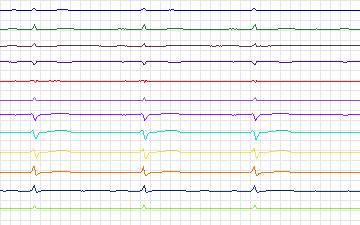 Electrocardiogram for T-Wave Alternans Challenge, record twa60