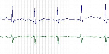 Electrocardiogram for T-Wave Alternans Challenge, record twa62