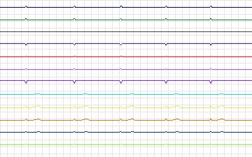 Electrocardiogram for T-Wave Alternans Challenge, record twa64