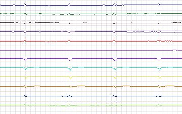 Electrocardiogram for T-Wave Alternans Challenge, record twa65