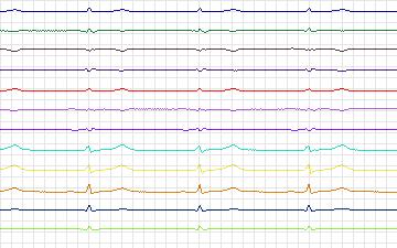 Electrocardiogram for T-Wave Alternans Challenge, record twa66