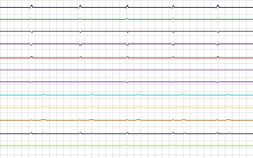 Electrocardiogram for T-Wave Alternans Challenge, record twa67