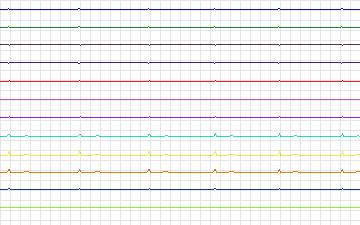 Electrocardiogram for T-Wave Alternans Challenge, record twa69