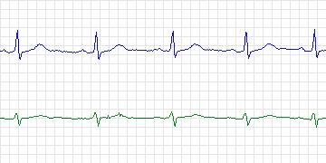 Electrocardiogram for T-Wave Alternans Challenge, record twa71