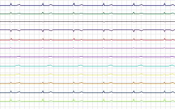 Electrocardiogram for T-Wave Alternans Challenge, record twa72