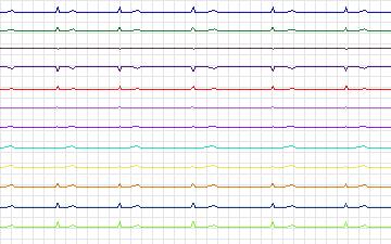 Electrocardiogram for T-Wave Alternans Challenge, record twa73