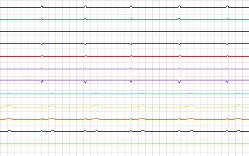 Electrocardiogram for T-Wave Alternans Challenge, record twa76