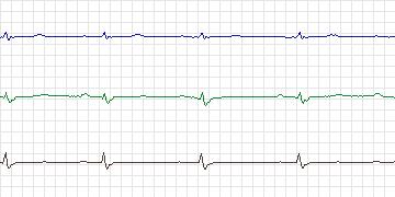 Electrocardiogram for T-Wave Alternans Challenge, record twa77