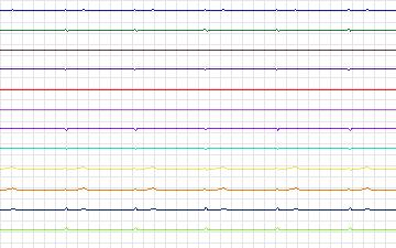 Electrocardiogram for T-Wave Alternans Challenge, record twa78
