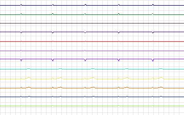 Electrocardiogram for T-Wave Alternans Challenge, record twa79
