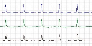 Electrocardiogram for T-Wave Alternans Challenge, record twa85