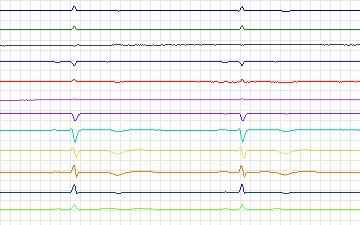 Electrocardiogram for T-Wave Alternans Challenge, record twa86