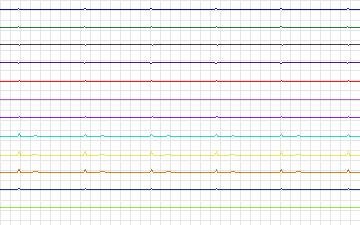 Electrocardiogram for T-Wave Alternans Challenge, record twa88