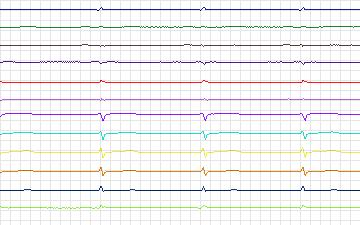 Electrocardiogram for T-Wave Alternans Challenge, record twa90