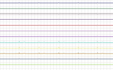 Electrocardiogram for T-Wave Alternans Challenge, record twa91
