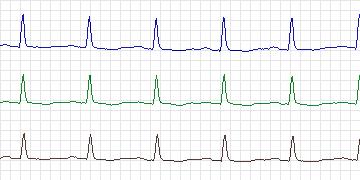 Electrocardiogram for T-Wave Alternans Challenge, record twa92