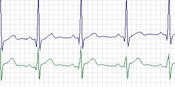 Electrocardiogram for T-Wave Alternans Challenge, record twa93