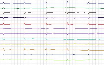 Electrocardiogram for T-Wave Alternans Challenge, record twa94