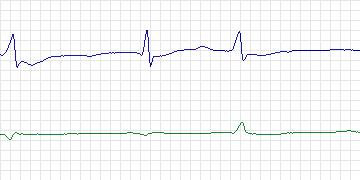 Electrocardiogram for T-Wave Alternans Challenge, record twa95