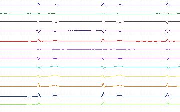 Electrocardiogram for T-Wave Alternans Challenge, record twa96