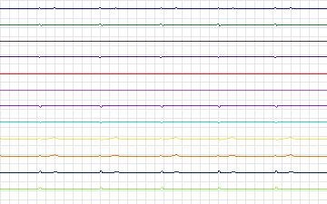 Electrocardiogram for T-Wave Alternans Challenge, record twa97