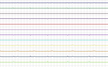 Electrocardiogram for T-Wave Alternans Challenge, record twa98
