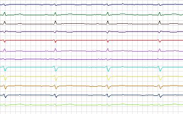 Electrocardiogram for T-Wave Alternans Challenge, record twa99