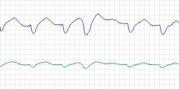Electrocardiogram for MIT-BIH Malignant Ventricular Arrhythmia, record 418
