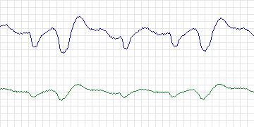 Electrocardiogram for MIT-BIH Malignant Ventricular Arrhythmia, record 419