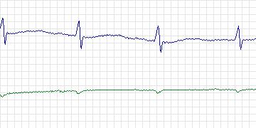 Electrocardiogram for MIT-BIH Malignant Ventricular Arrhythmia, record 420