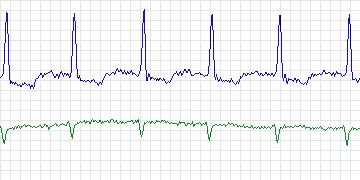 Electrocardiogram for MIT-BIH Malignant Ventricular Arrhythmia, record 421