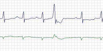 Electrocardiogram for MIT-BIH Malignant Ventricular Arrhythmia, record 422