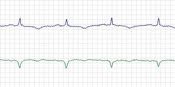 Electrocardiogram for MIT-BIH Malignant Ventricular Arrhythmia, record 423
