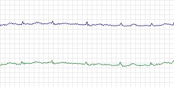 Electrocardiogram for MIT-BIH Malignant Ventricular Arrhythmia, record 424