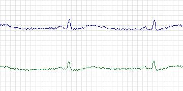 Electrocardiogram for MIT-BIH Malignant Ventricular Arrhythmia, record 425
