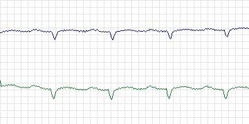Electrocardiogram for MIT-BIH Malignant Ventricular Arrhythmia, record 428