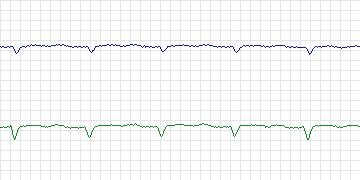 Electrocardiogram for MIT-BIH Malignant Ventricular Arrhythmia, record 429