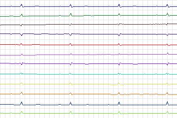 Electrocardiogram for PTB Diagnostic ECG, record s0372lre-patient089